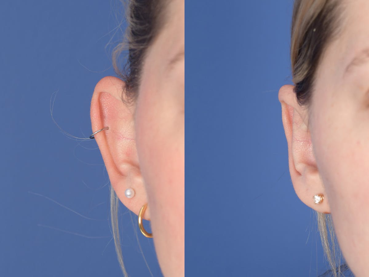 Otoplasty Before & After Gallery - Patient 330713 - Image 2