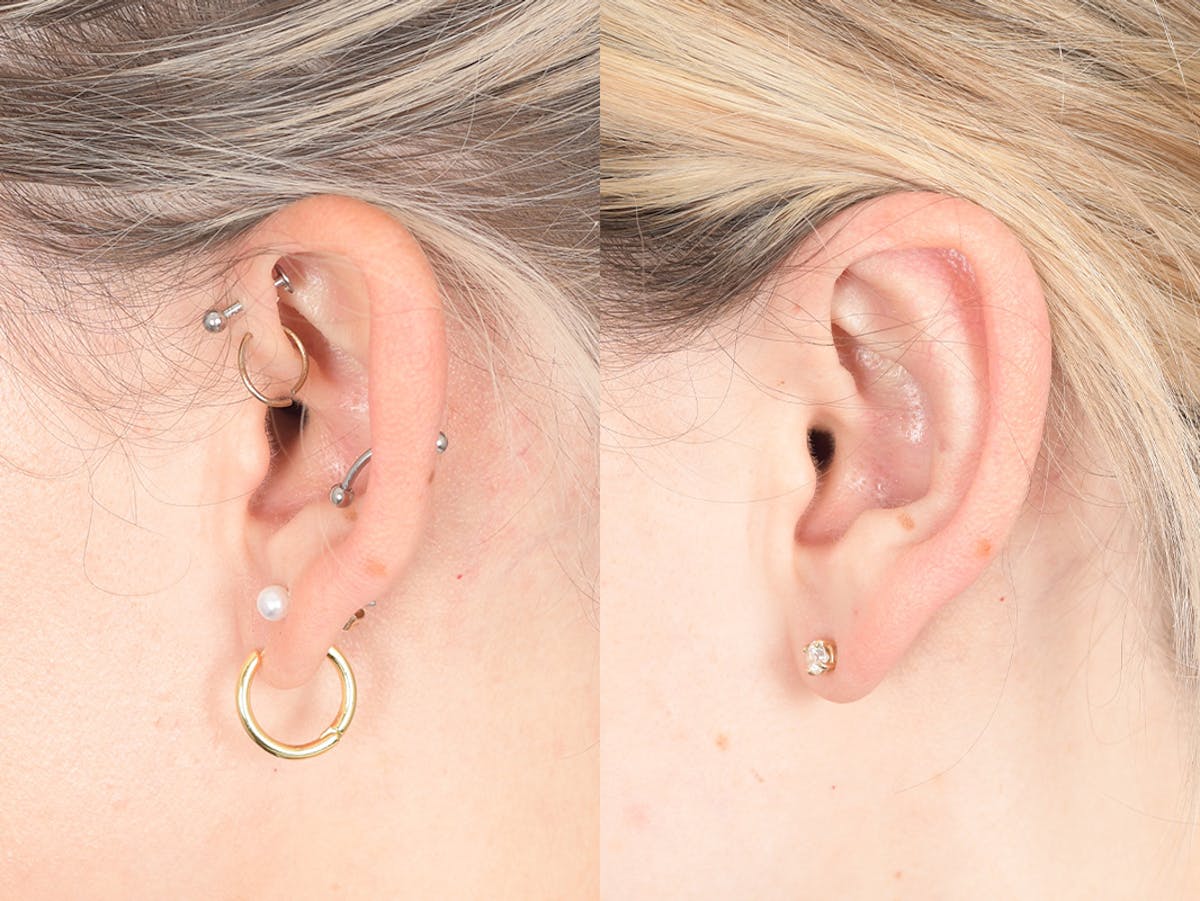 Otoplasty Before & After Gallery - Patient 330713 - Image 3