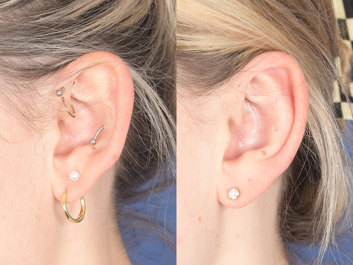 Otoplasty Before & After Gallery - Patient 330713 - Image 4