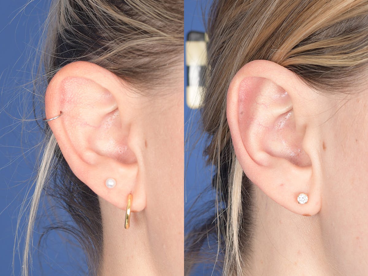 Otoplasty Before & After Gallery - Patient 330713 - Image 5