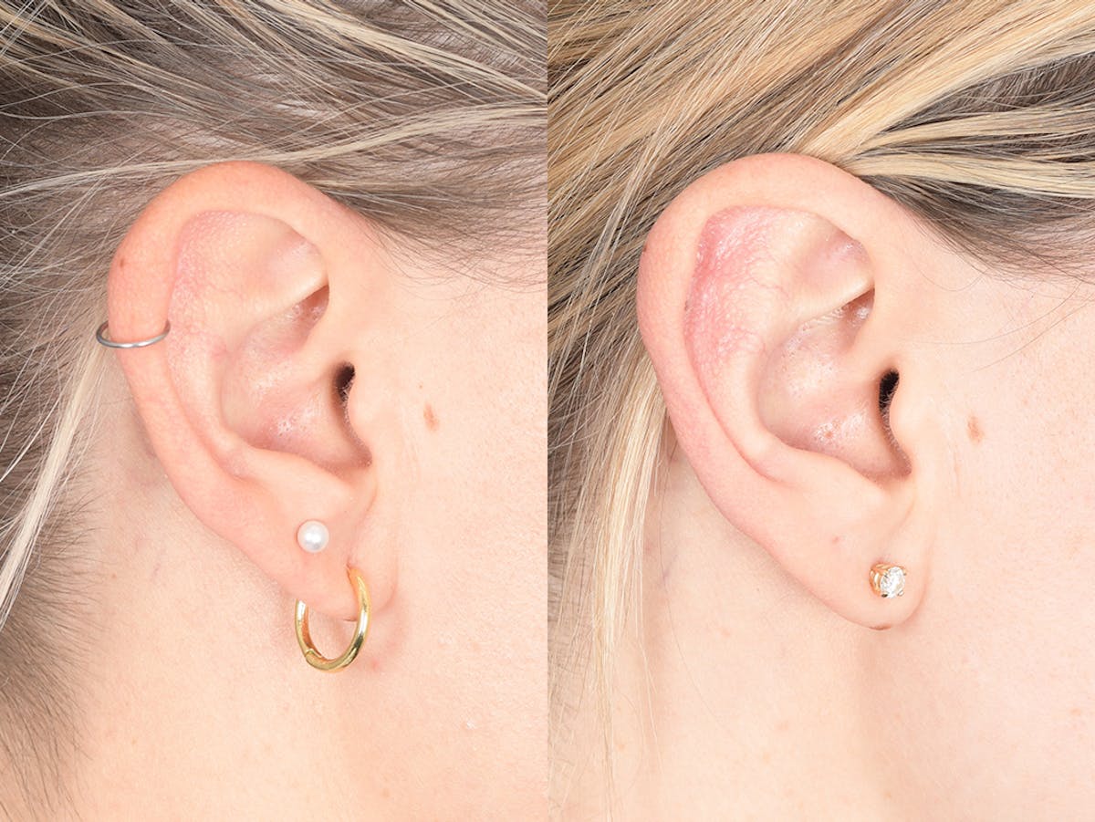 Otoplasty Before & After Gallery - Patient 330713 - Image 6