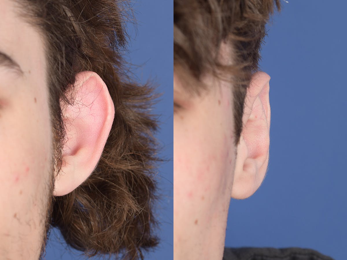 Otoplasty Before & After Gallery - Patient 757053 - Image 1