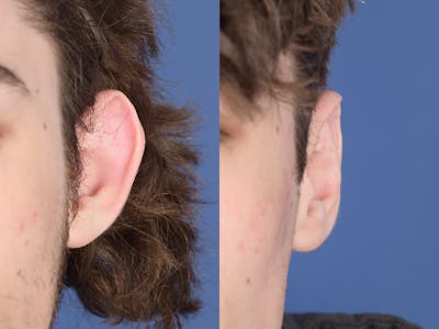 Otoplasty Before & After Gallery - Patient 757053 - Image 1