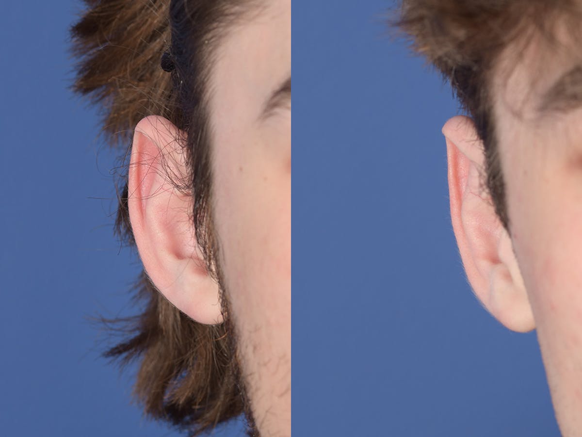 Otoplasty Before & After Gallery - Patient 757053 - Image 2
