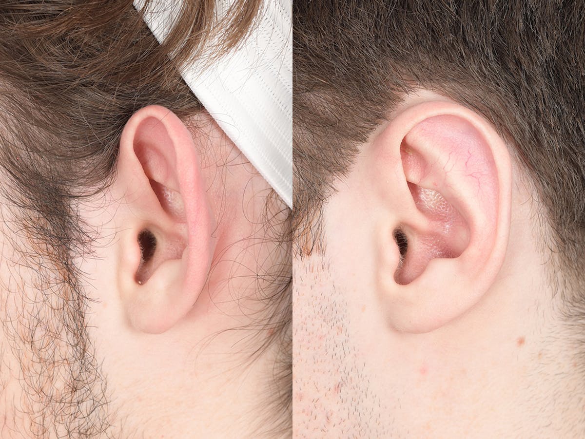 Otoplasty Before & After Gallery - Patient 757053 - Image 3