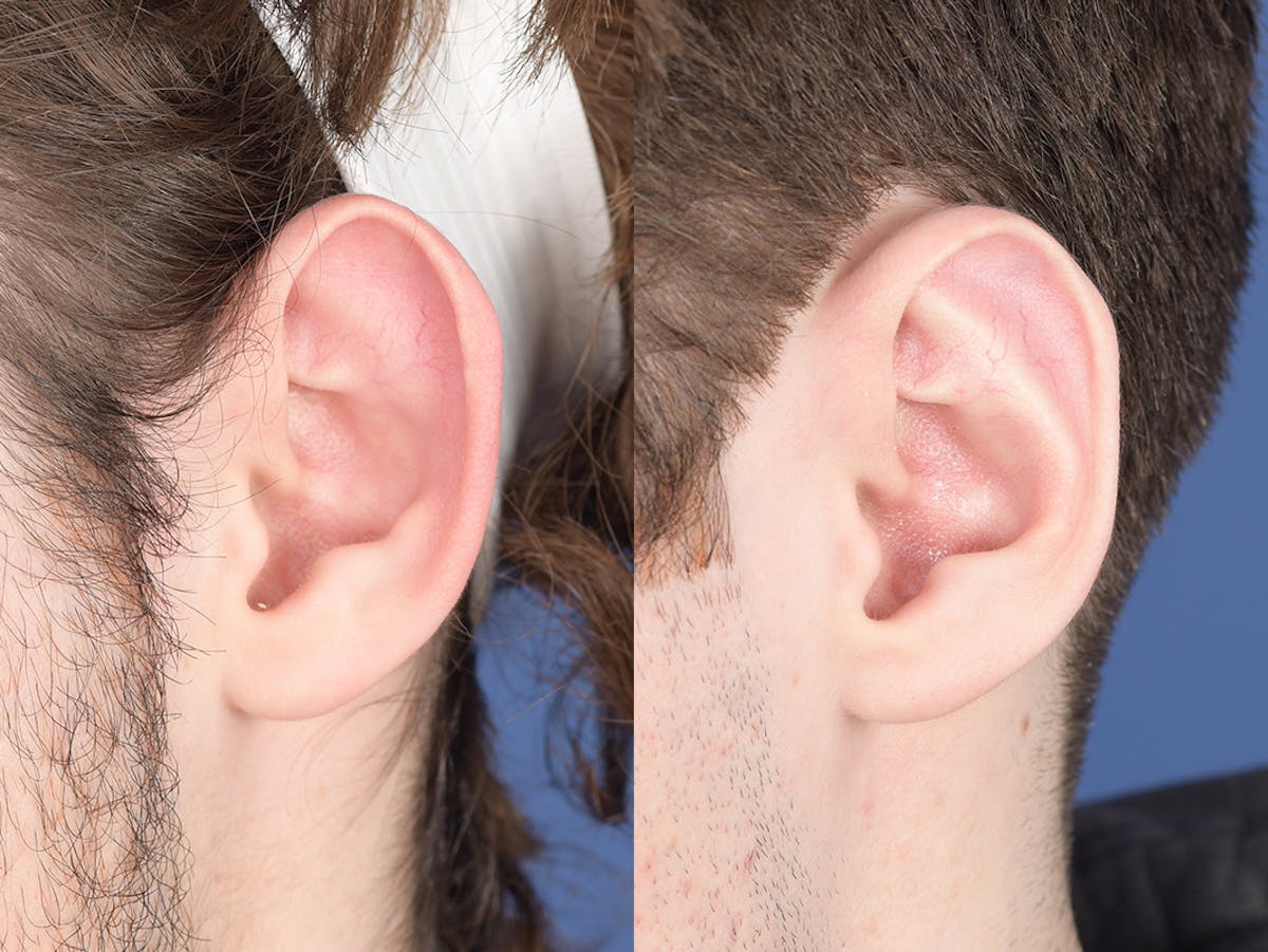 Otoplasty Before & After Gallery - Patient 757053 - Image 4