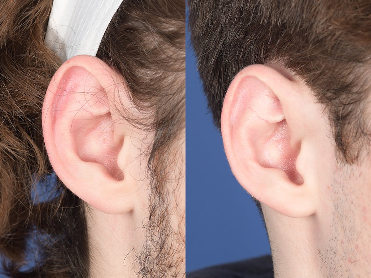 Otoplasty Before & After Gallery - Patient 757053 - Image 5