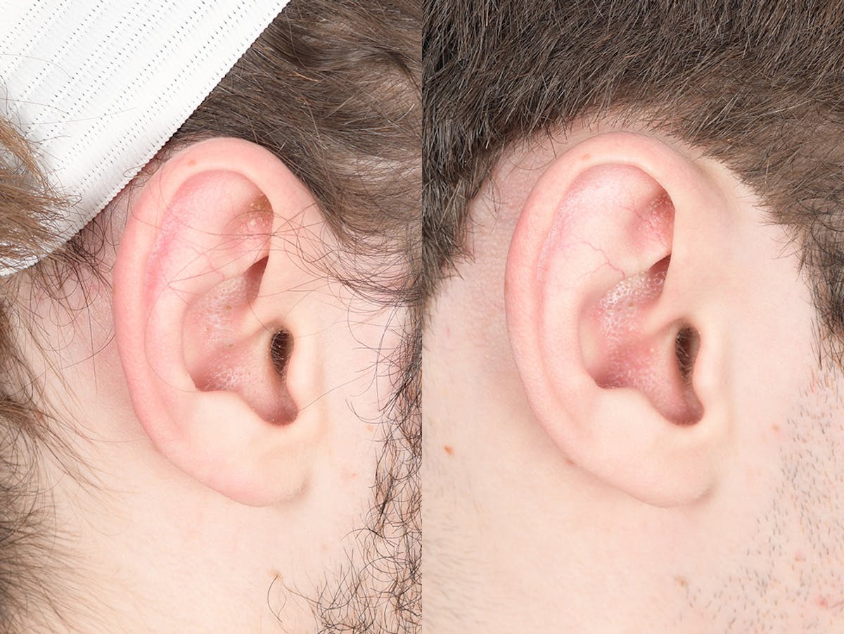 Otoplasty Before & After Gallery - Patient 757053 - Image 6