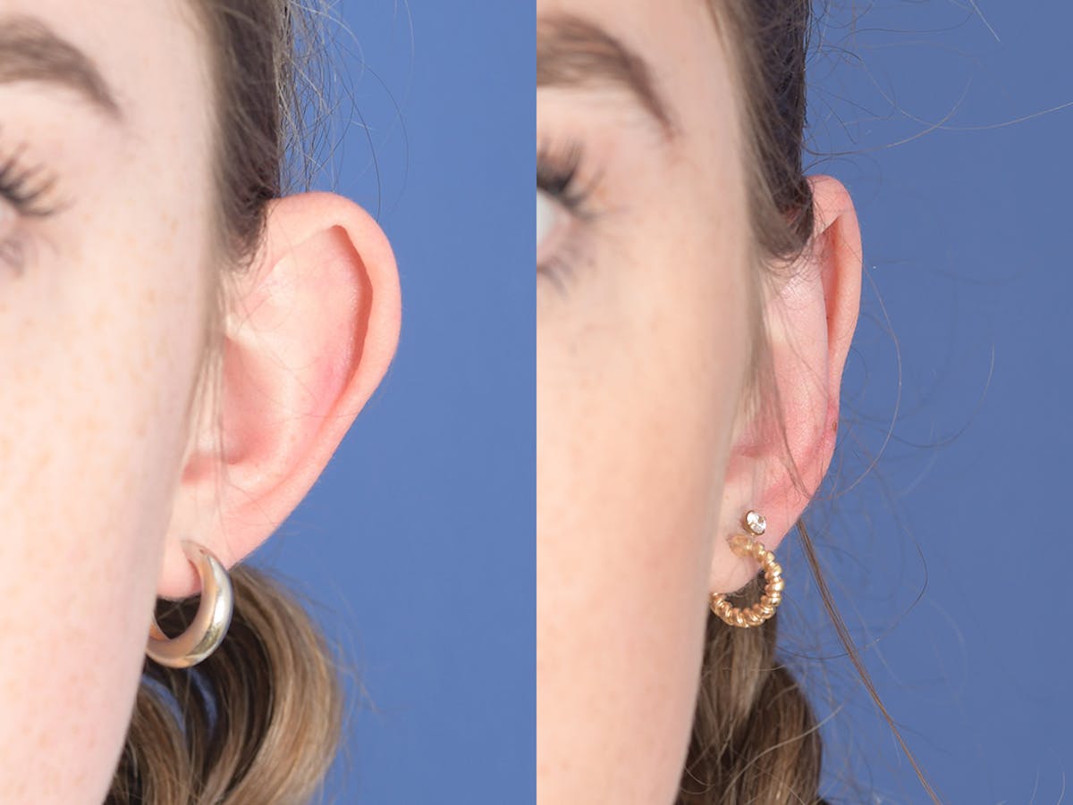 Otoplasty Before & After Gallery - Patient 399236 - Image 1