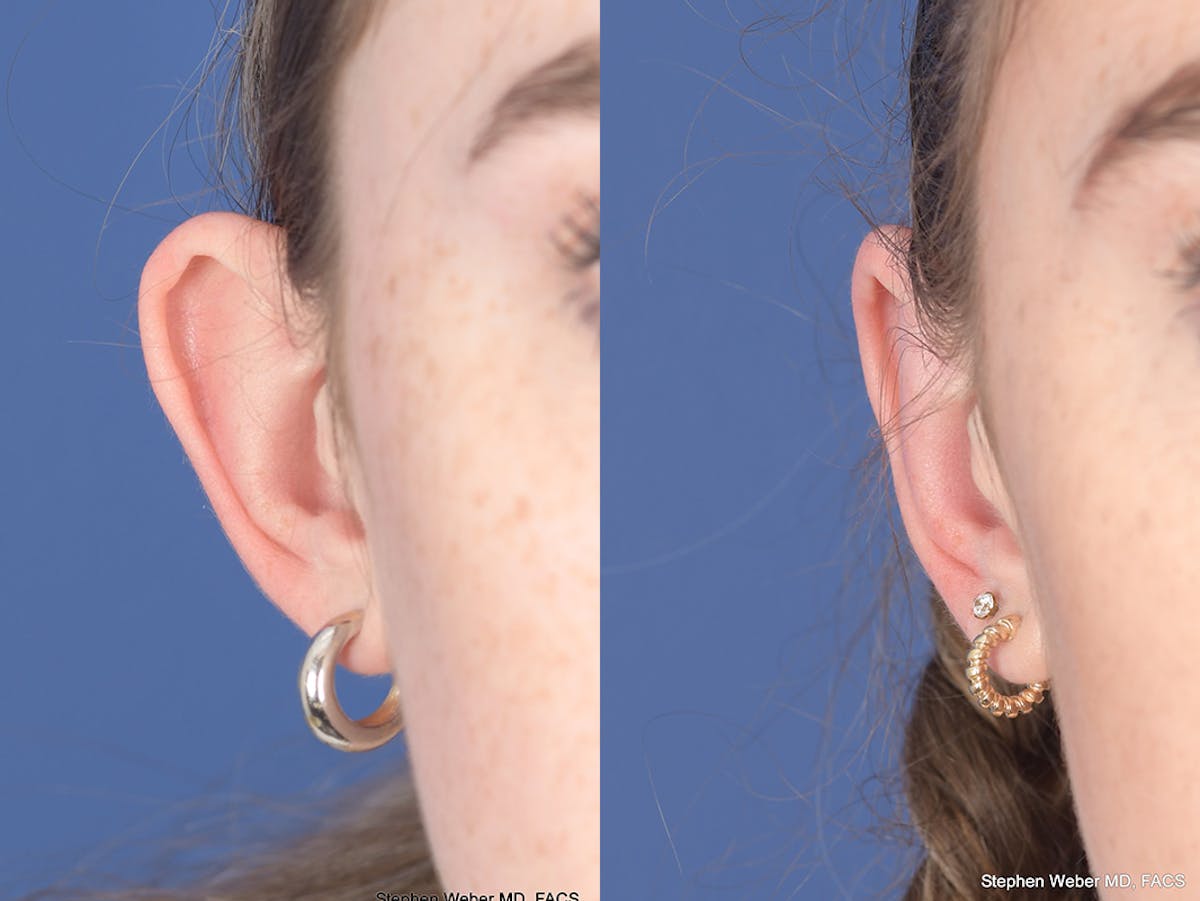 Otoplasty Before & After Gallery - Patient 399236 - Image 2