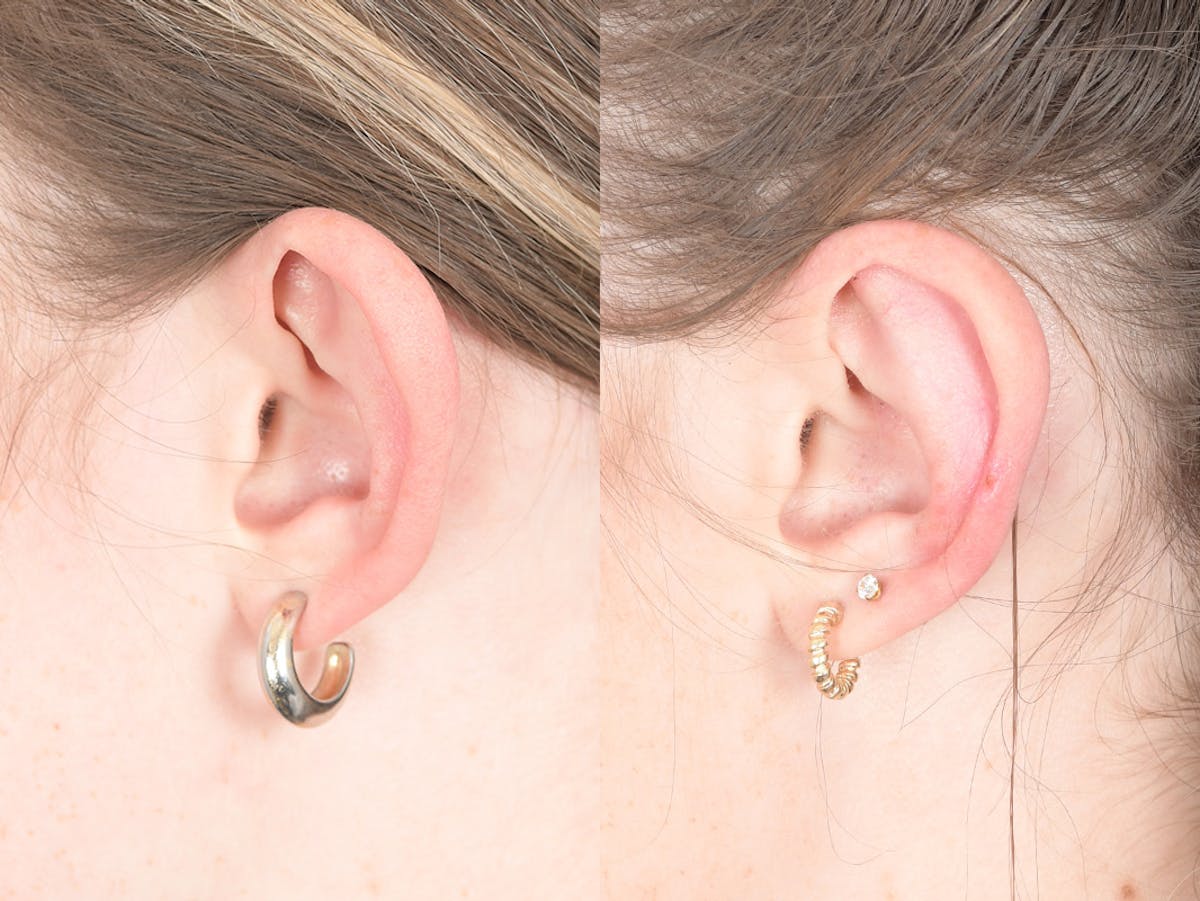 Otoplasty Before & After Gallery - Patient 399236 - Image 3