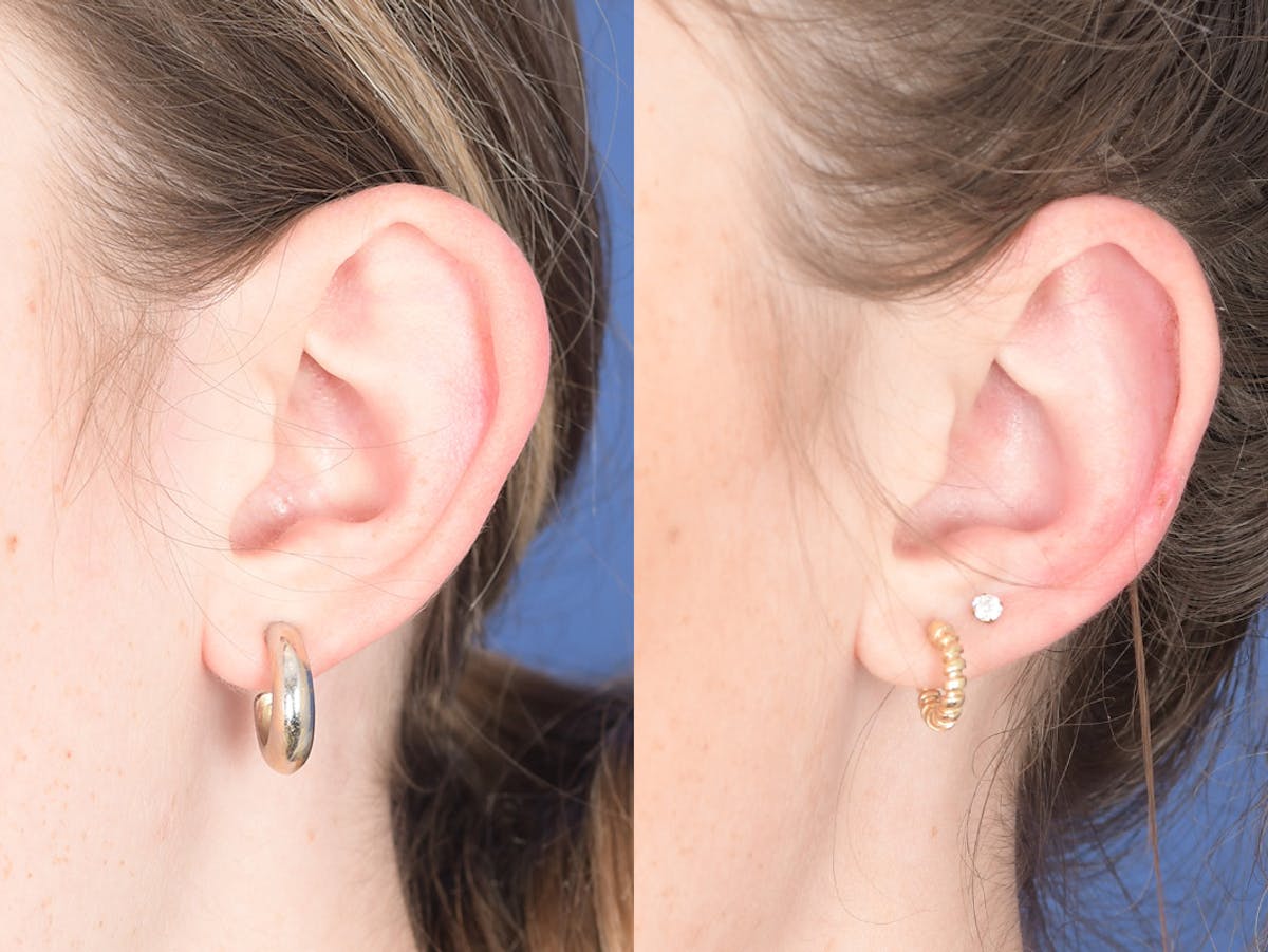 Otoplasty Before & After Gallery - Patient 399236 - Image 4