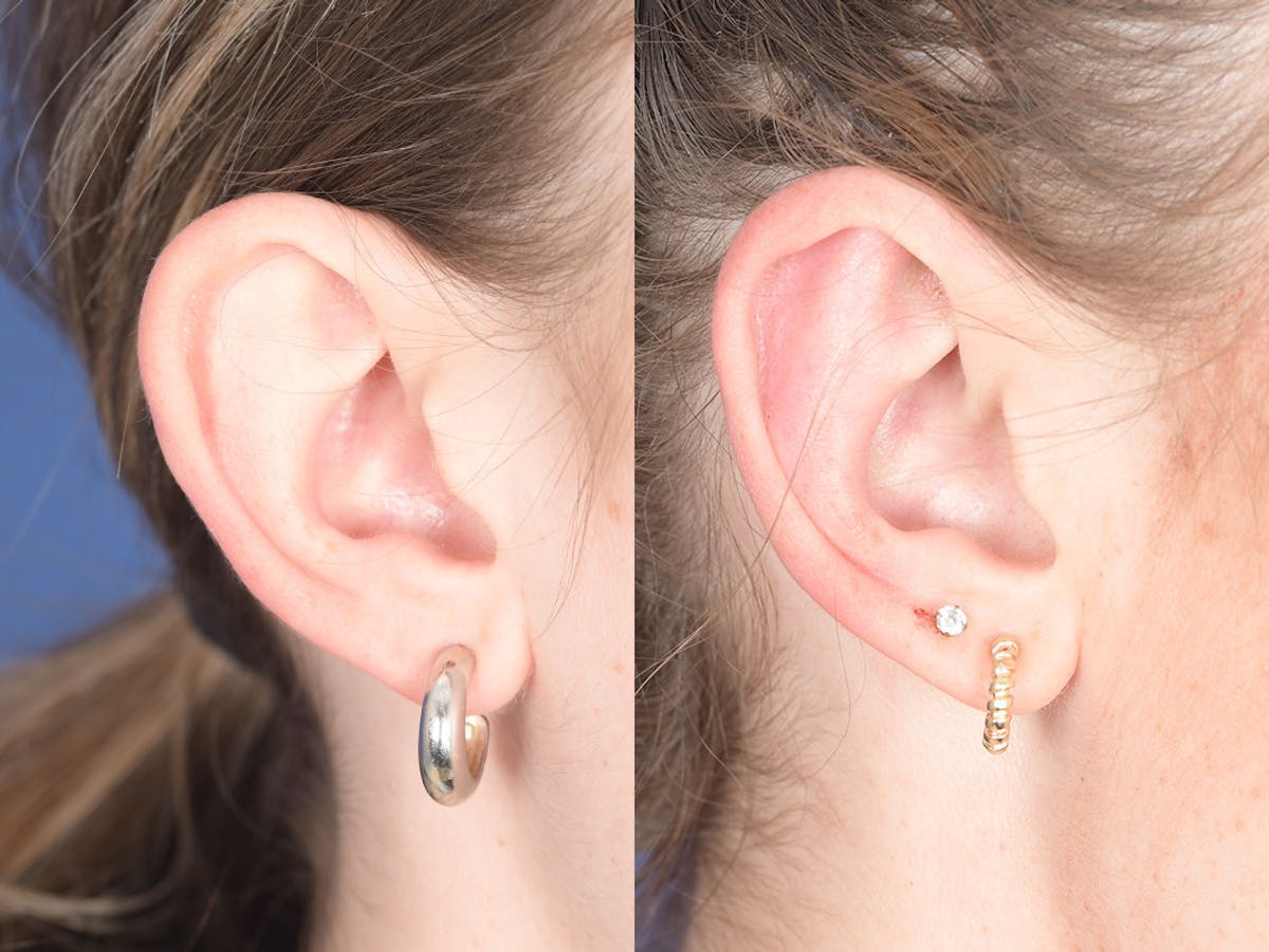 Otoplasty Before & After Gallery - Patient 399236 - Image 5