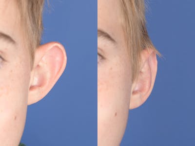 Otoplasty Before & After Gallery - Patient 622946 - Image 1