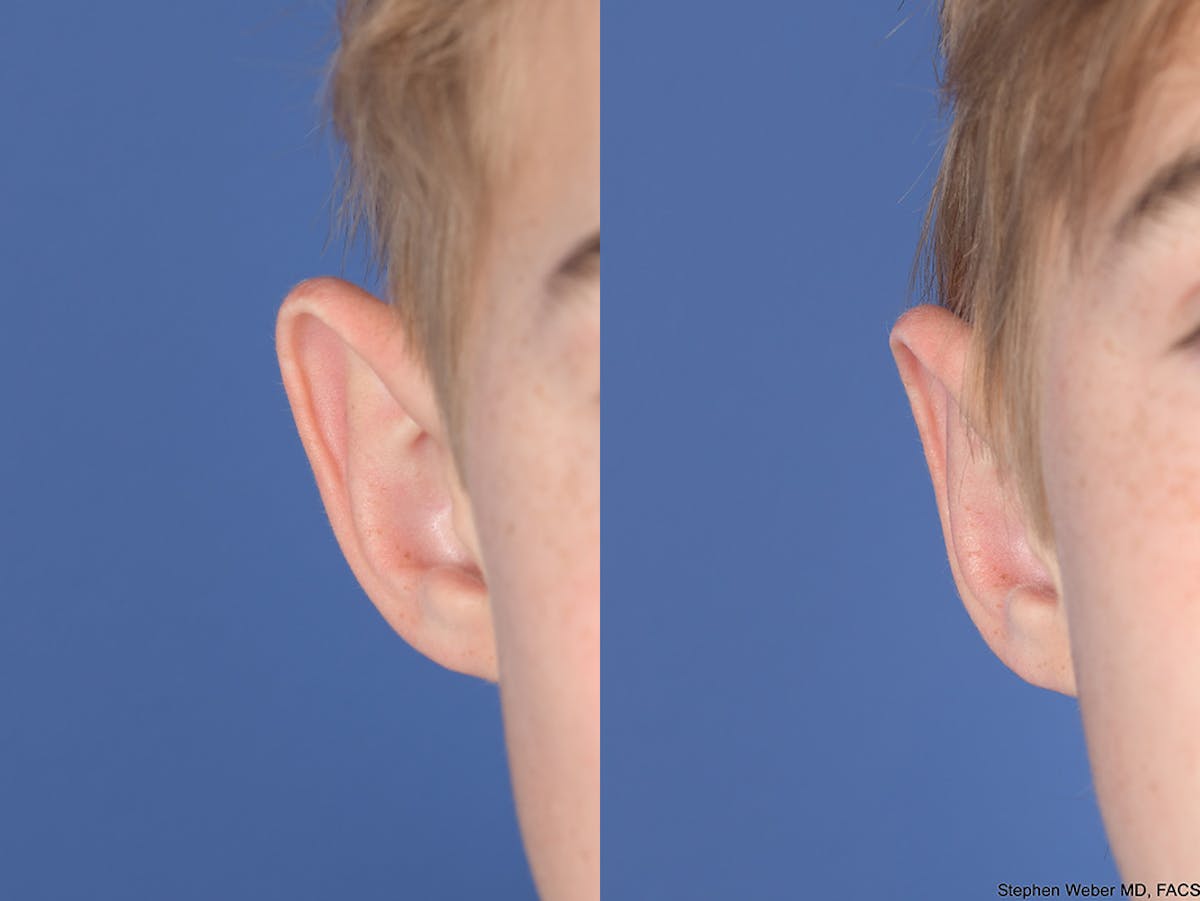 Otoplasty Before & After Gallery - Patient 622946 - Image 2