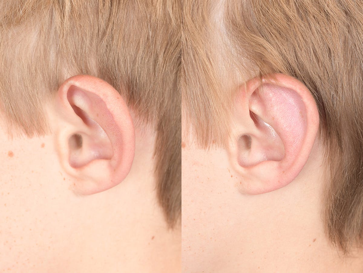 Otoplasty Before & After Gallery - Patient 622946 - Image 3