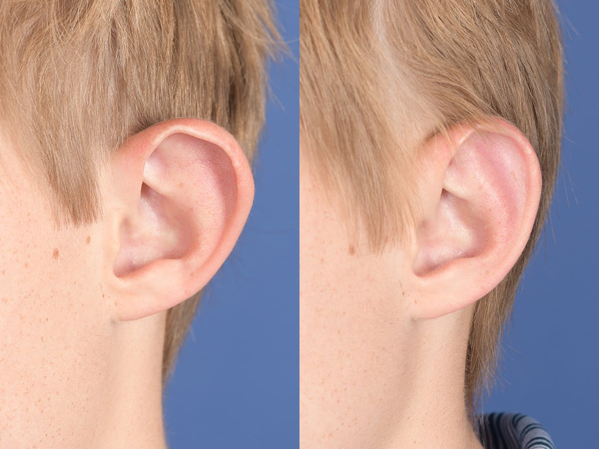 Otoplasty Before & After Gallery - Patient 622946 - Image 4