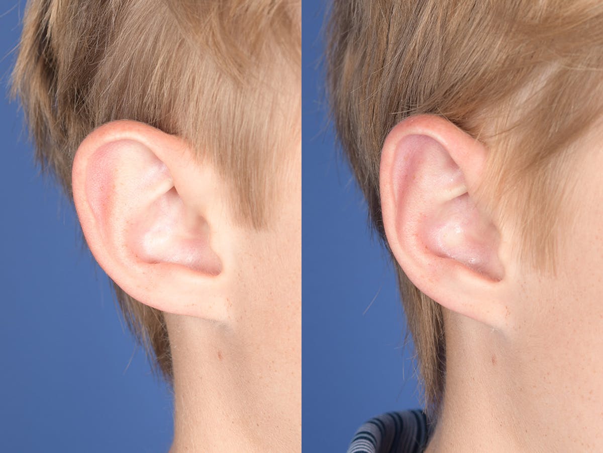 Otoplasty Before & After Gallery - Patient 622946 - Image 5