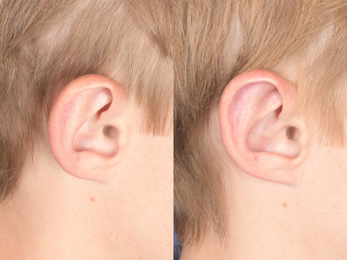 Otoplasty Before & After Gallery - Patient 622946 - Image 6
