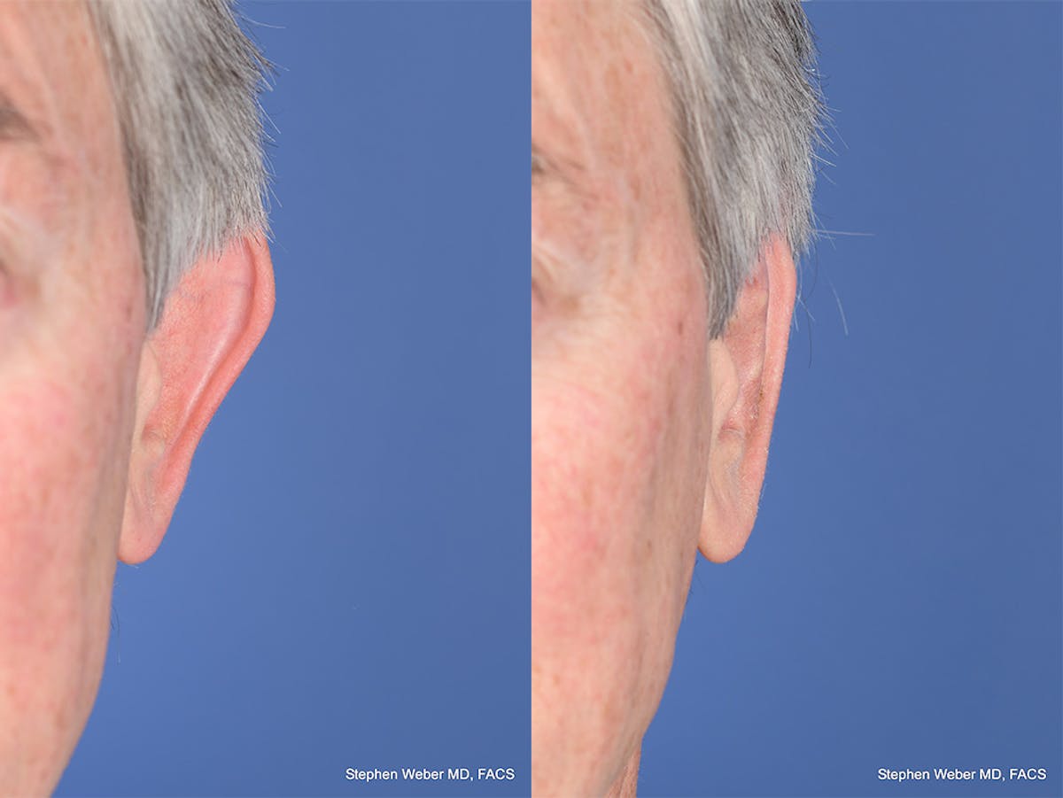 Otoplasty Before & After Gallery - Patient 332300 - Image 1