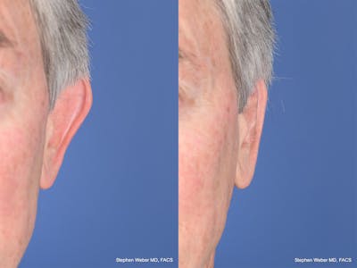 Otoplasty Before & After Gallery - Patient 332300 - Image 1
