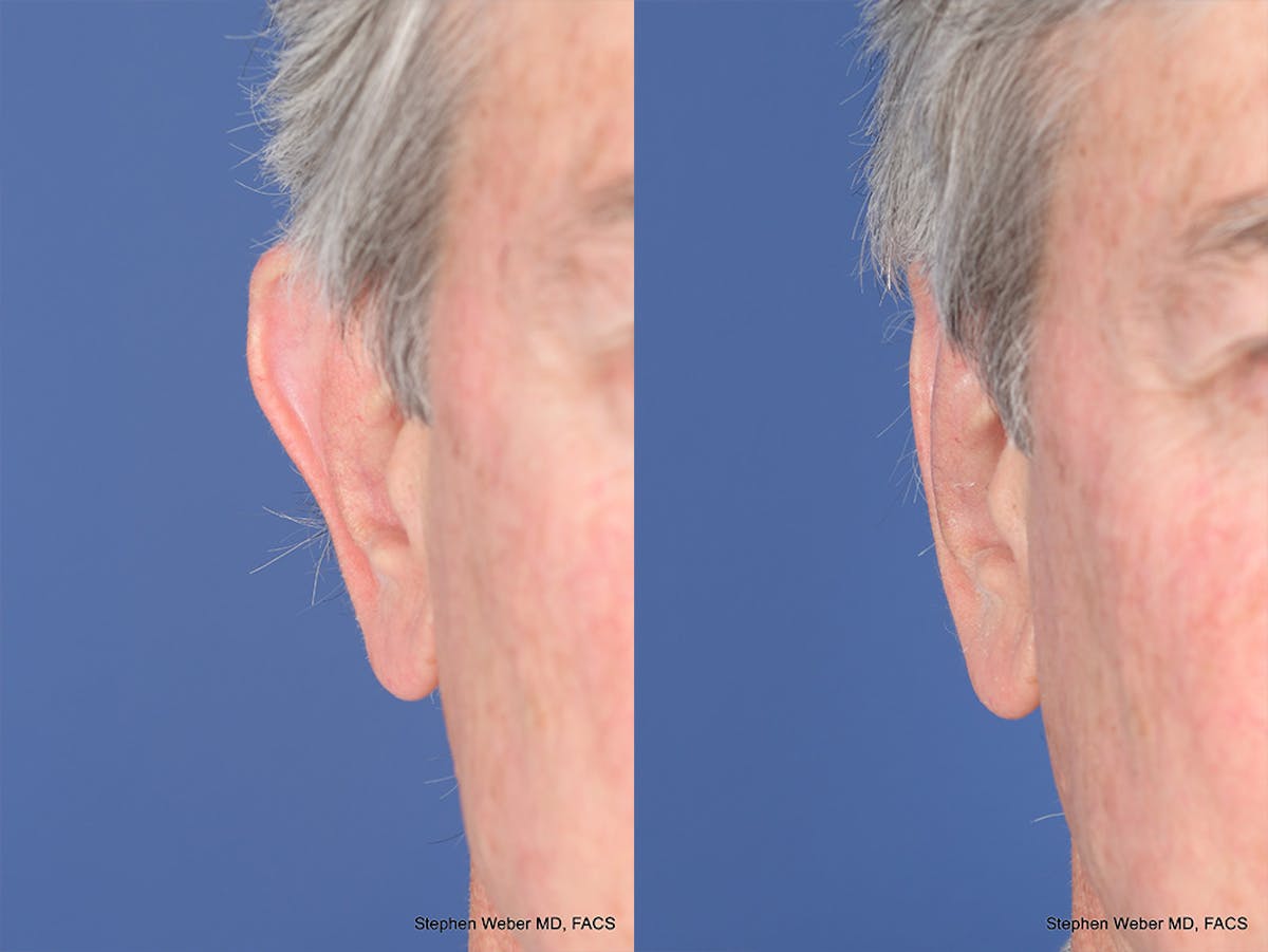Otoplasty Before & After Gallery - Patient 332300 - Image 2