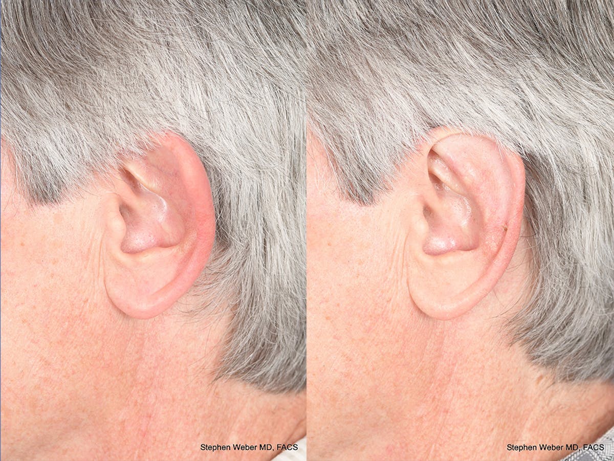 Otoplasty Before & After Gallery - Patient 332300 - Image 3