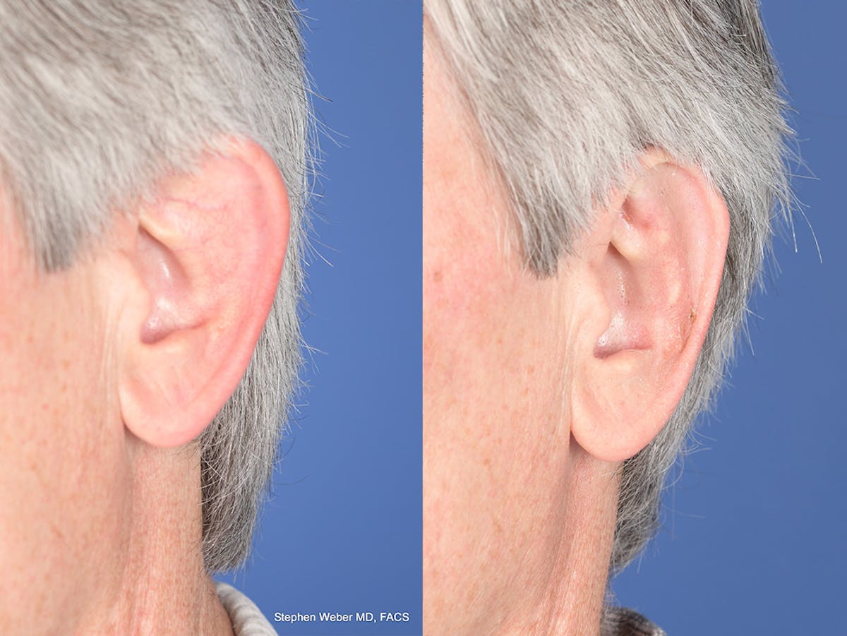 Otoplasty Before & After Gallery - Patient 332300 - Image 4