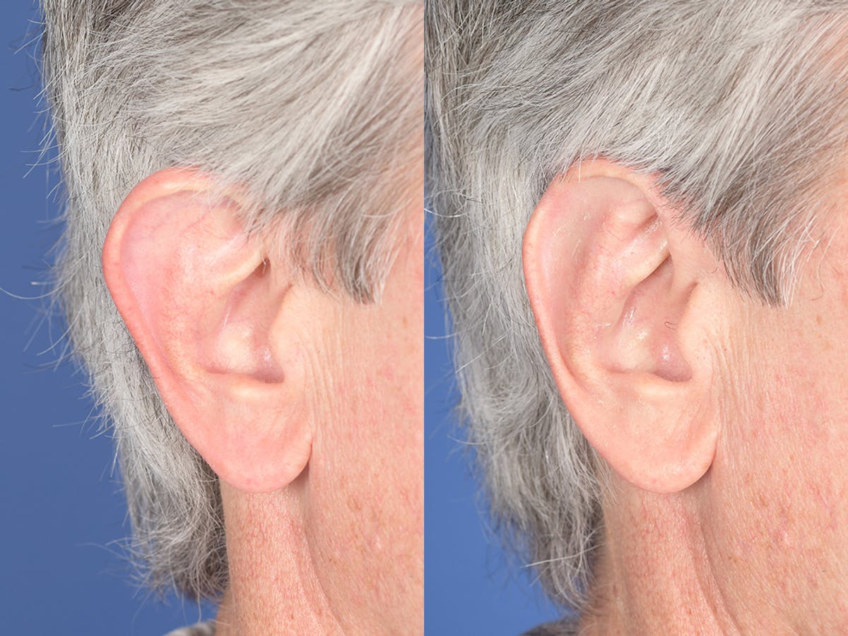 Otoplasty Before & After Gallery - Patient 332300 - Image 5