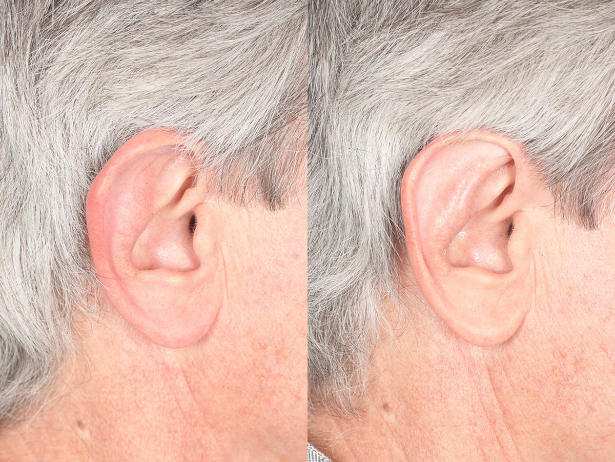 Otoplasty Before & After Gallery - Patient 332300 - Image 6