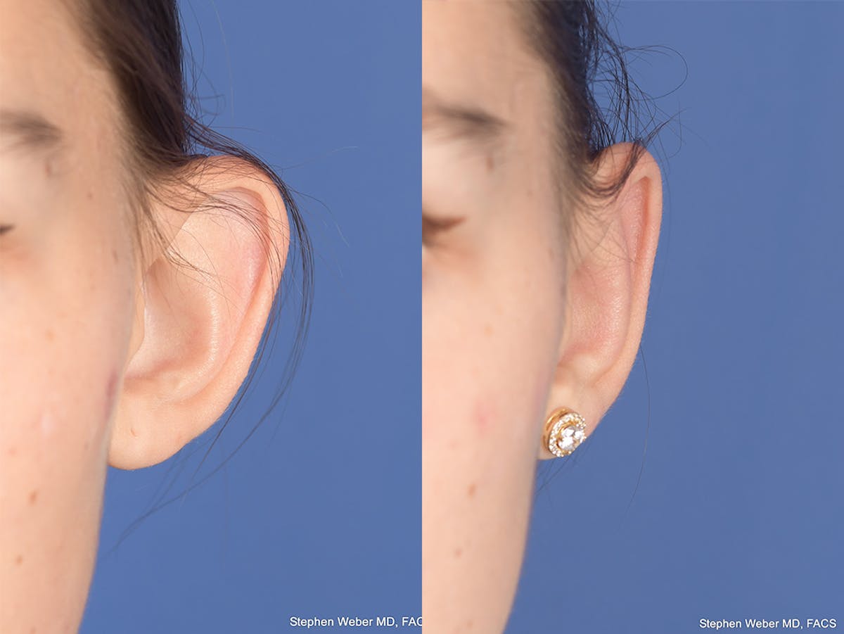 Otoplasty Before & After Gallery - Patient 334982 - Image 1