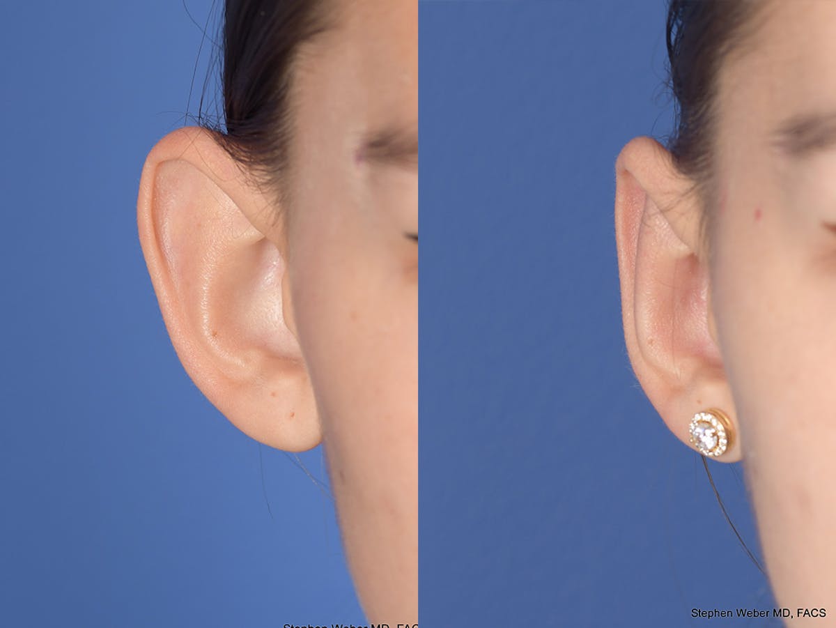 Otoplasty Before & After Gallery - Patient 334982 - Image 2