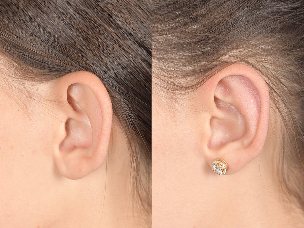 Otoplasty Before & After Gallery - Patient 334982 - Image 3