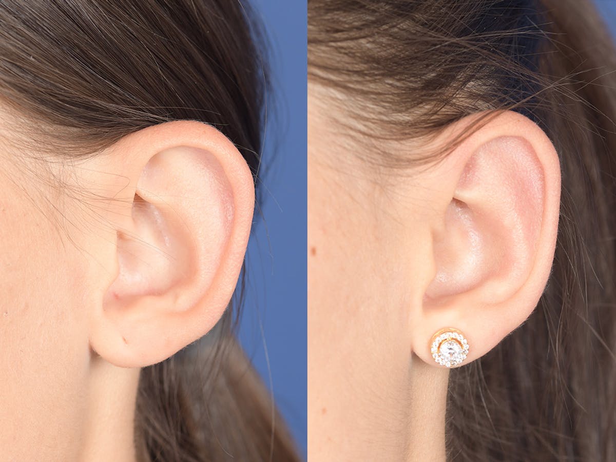 Otoplasty Before & After Gallery - Patient 334982 - Image 4