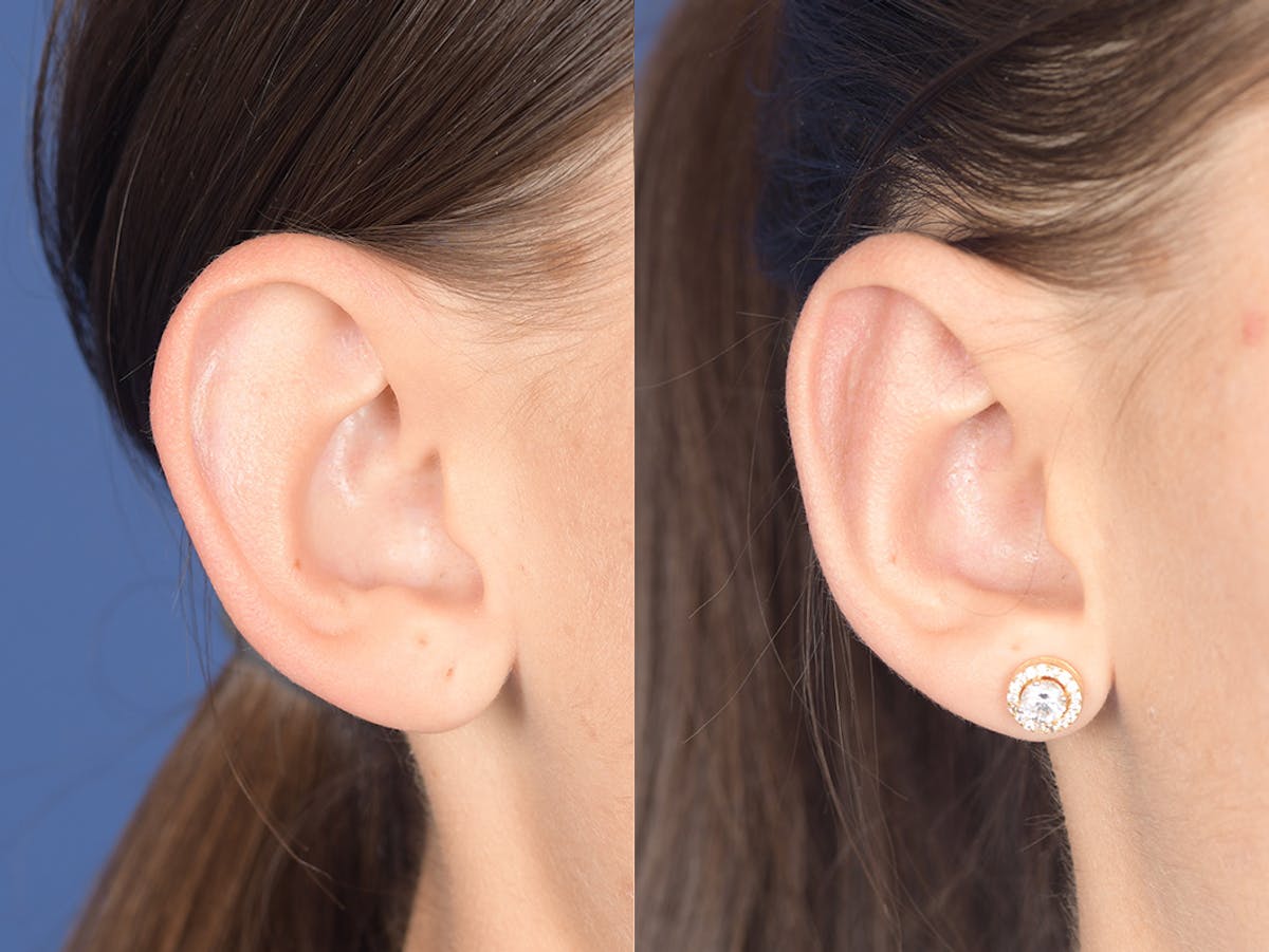 Otoplasty Before & After Gallery - Patient 334982 - Image 5