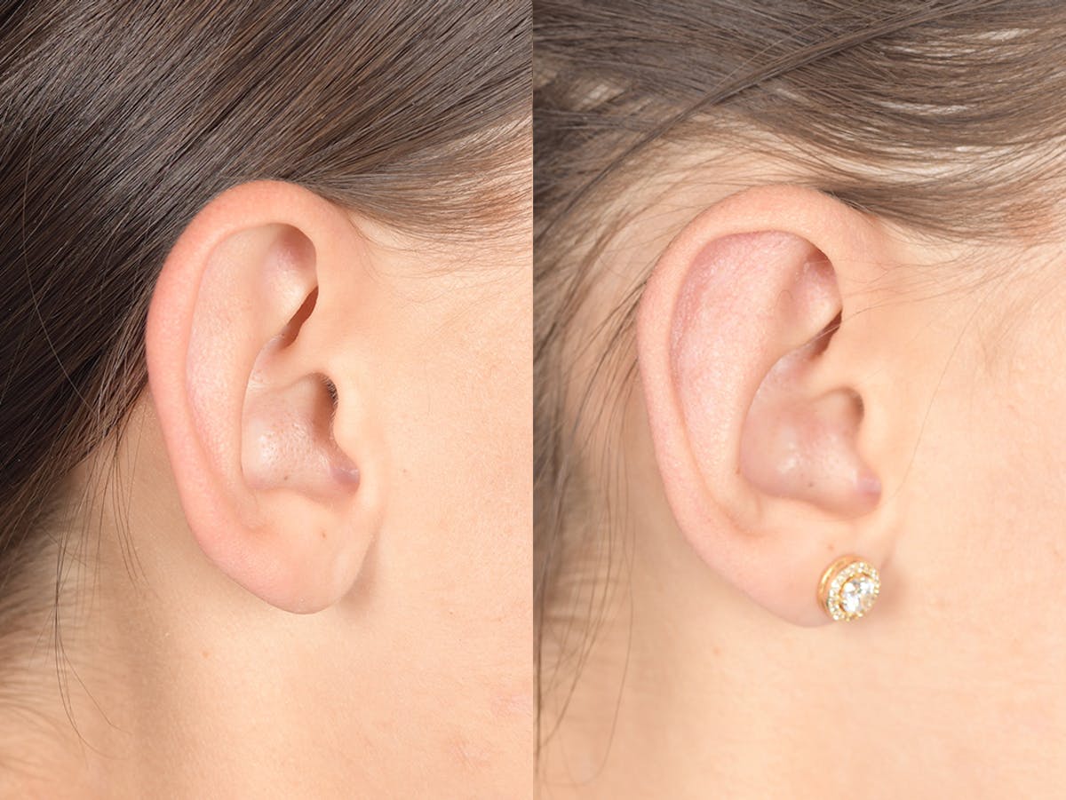 Otoplasty Before & After Gallery - Patient 334982 - Image 6