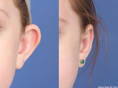 Otoplasty Before & After Gallery - Patient 234650 - Image 1