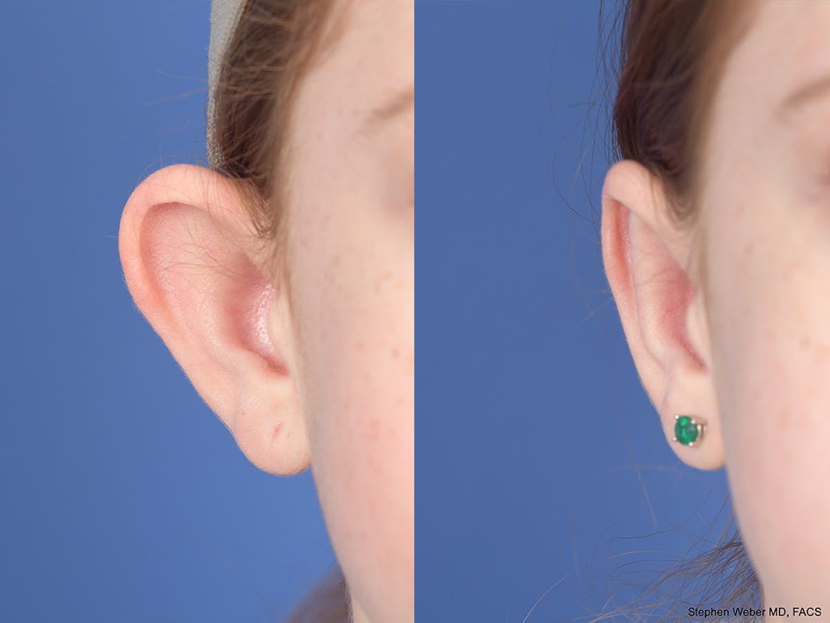 Otoplasty Before & After Gallery - Patient 234650 - Image 2