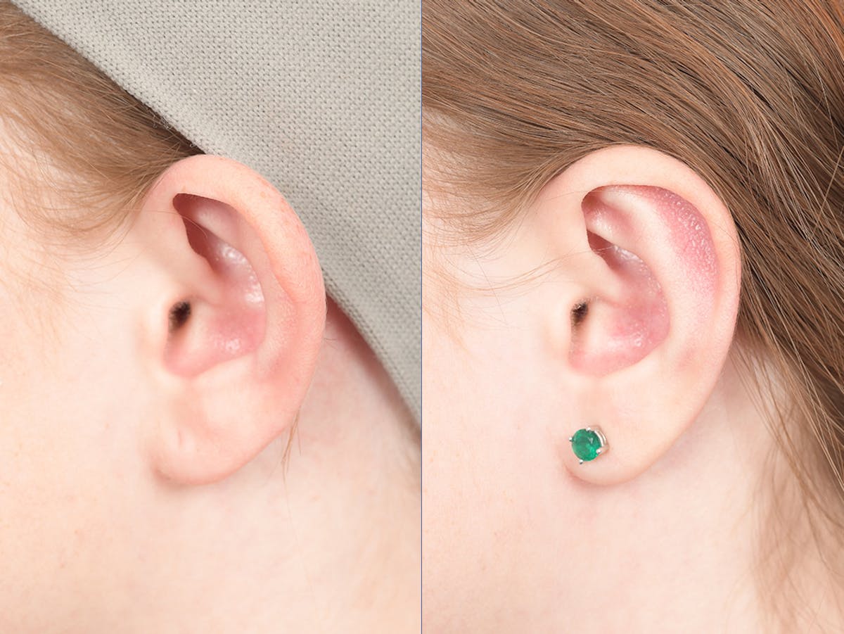 Otoplasty Before & After Gallery - Patient 234650 - Image 3