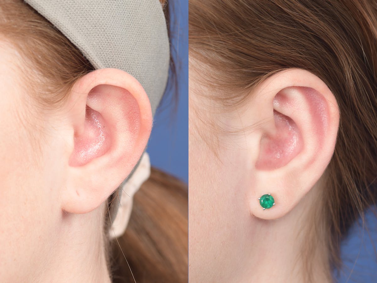 Otoplasty Before & After Gallery - Patient 234650 - Image 4