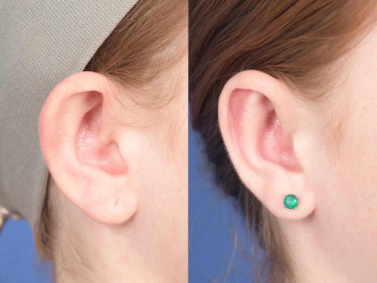 Otoplasty Before & After Gallery - Patient 234650 - Image 5
