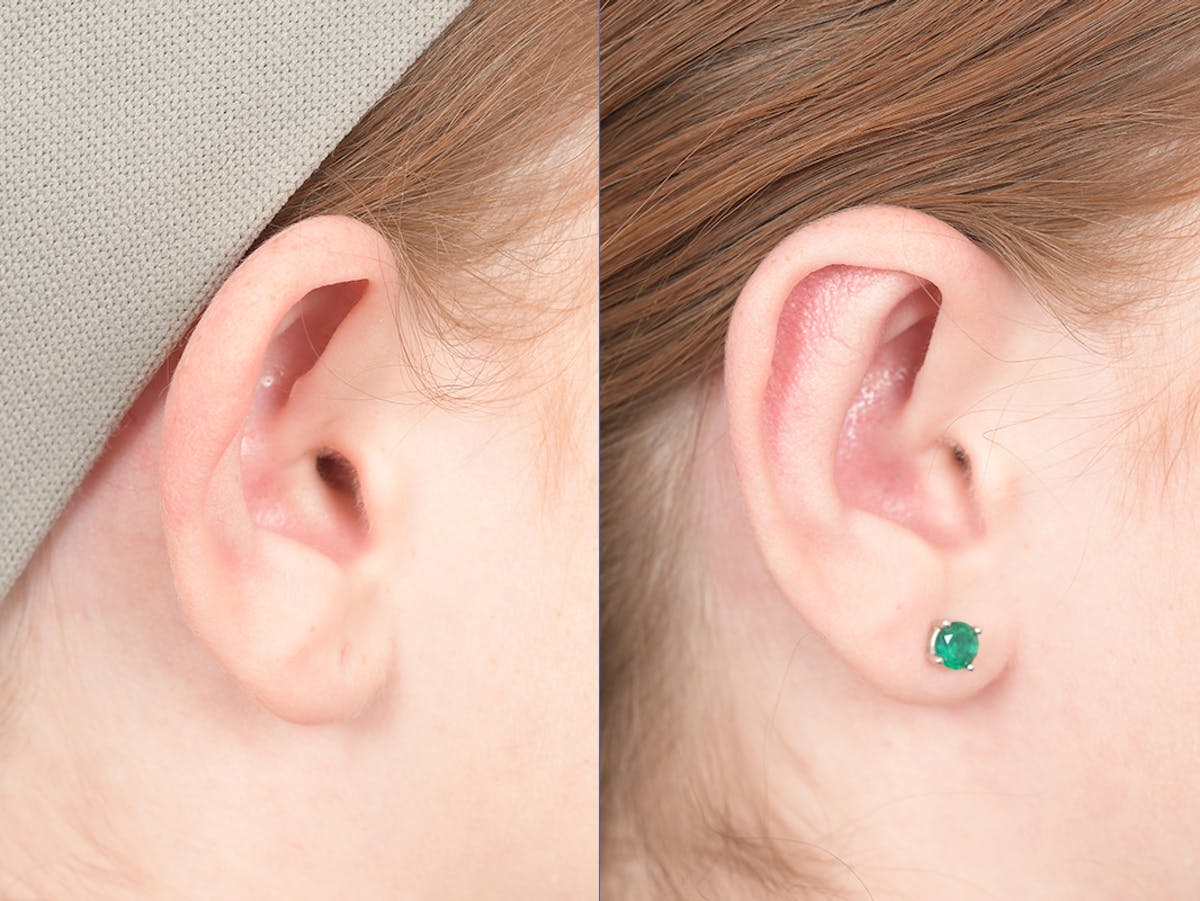 Otoplasty Before & After Gallery - Patient 234650 - Image 6