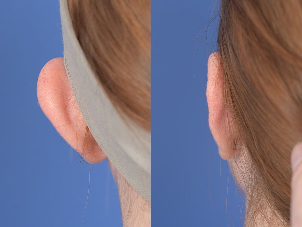 Otoplasty Before & After Gallery - Patient 234650 - Image 7