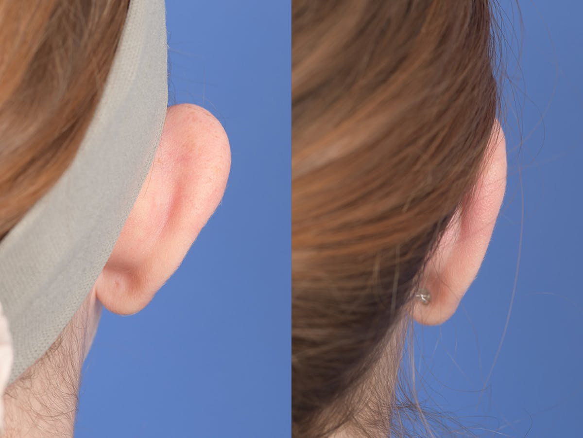 Otoplasty Before & After Gallery - Patient 234650 - Image 8