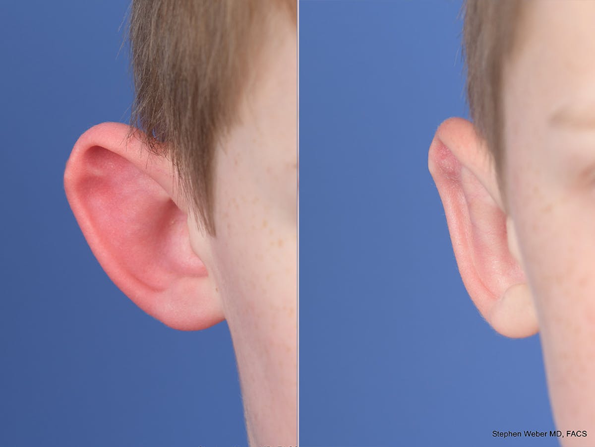 Otoplasty Before & After Gallery - Patient 521956 - Image 2