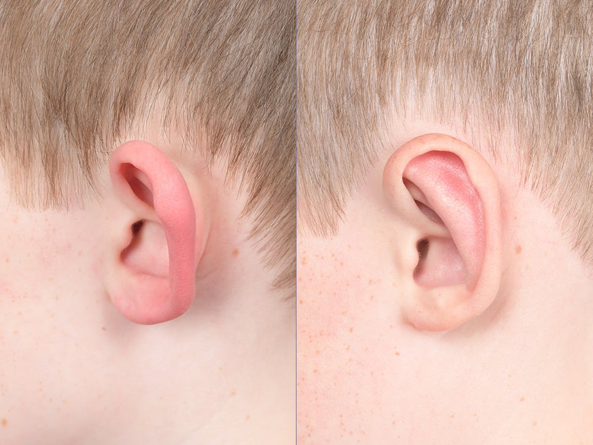 Otoplasty Before & After Gallery - Patient 521956 - Image 3