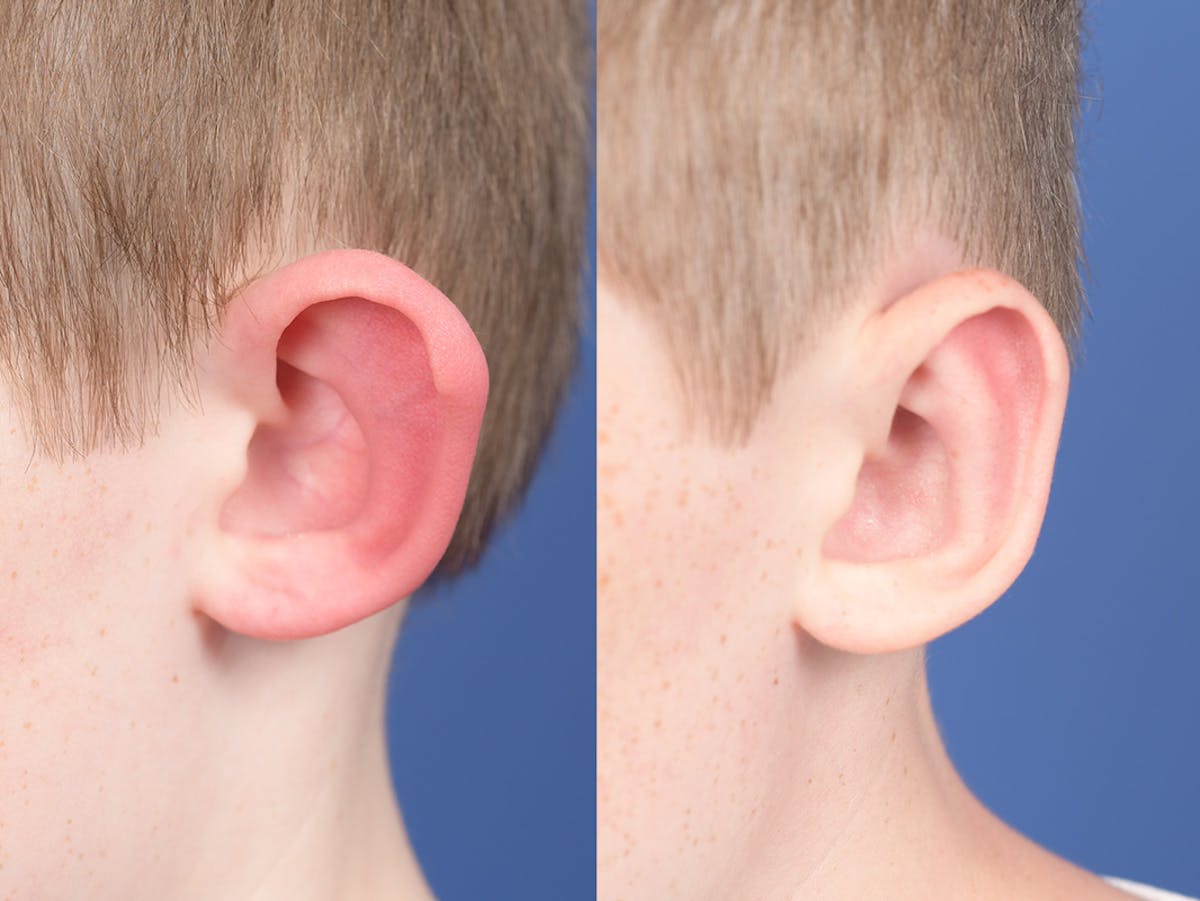 Otoplasty Before & After Gallery - Patient 521956 - Image 4