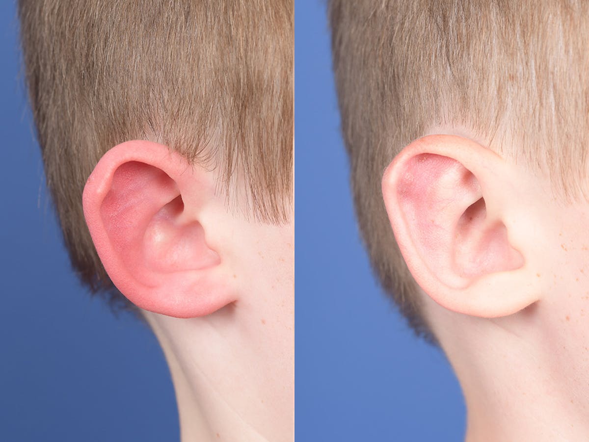 Otoplasty Before & After Gallery - Patient 521956 - Image 5