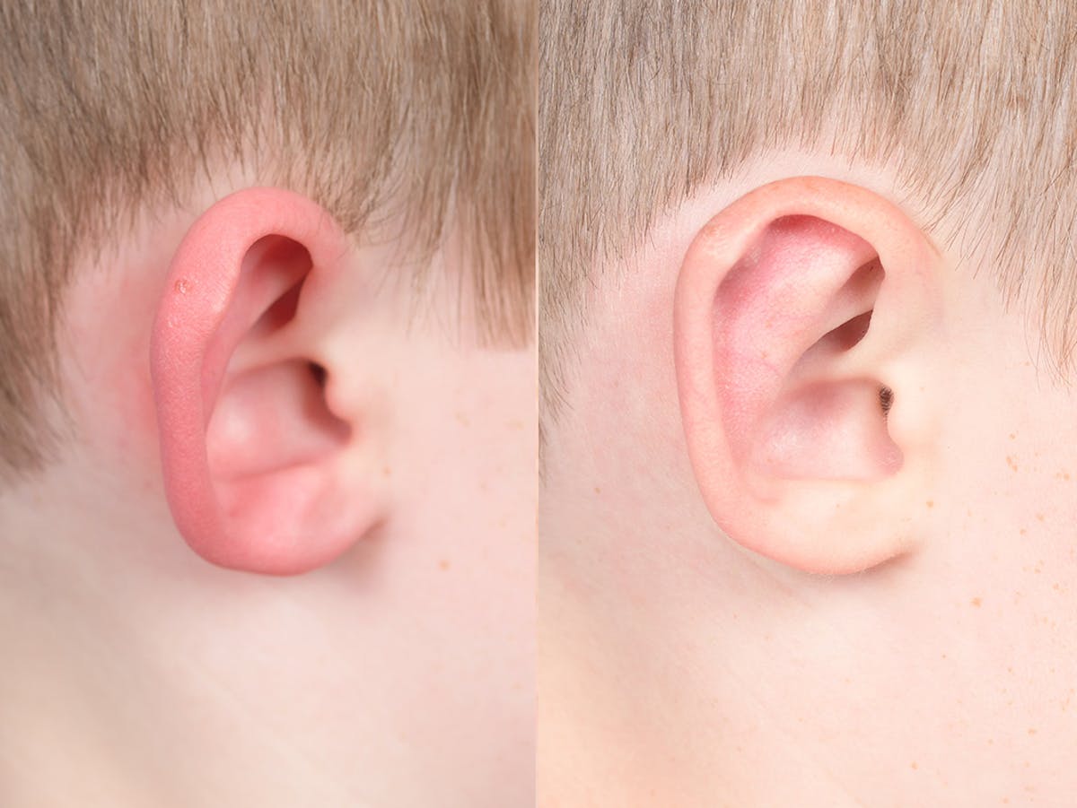 Otoplasty Before & After Gallery - Patient 521956 - Image 6