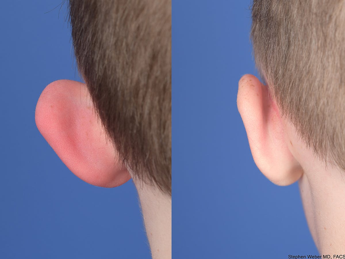 Otoplasty Before & After Gallery - Patient 521956 - Image 7